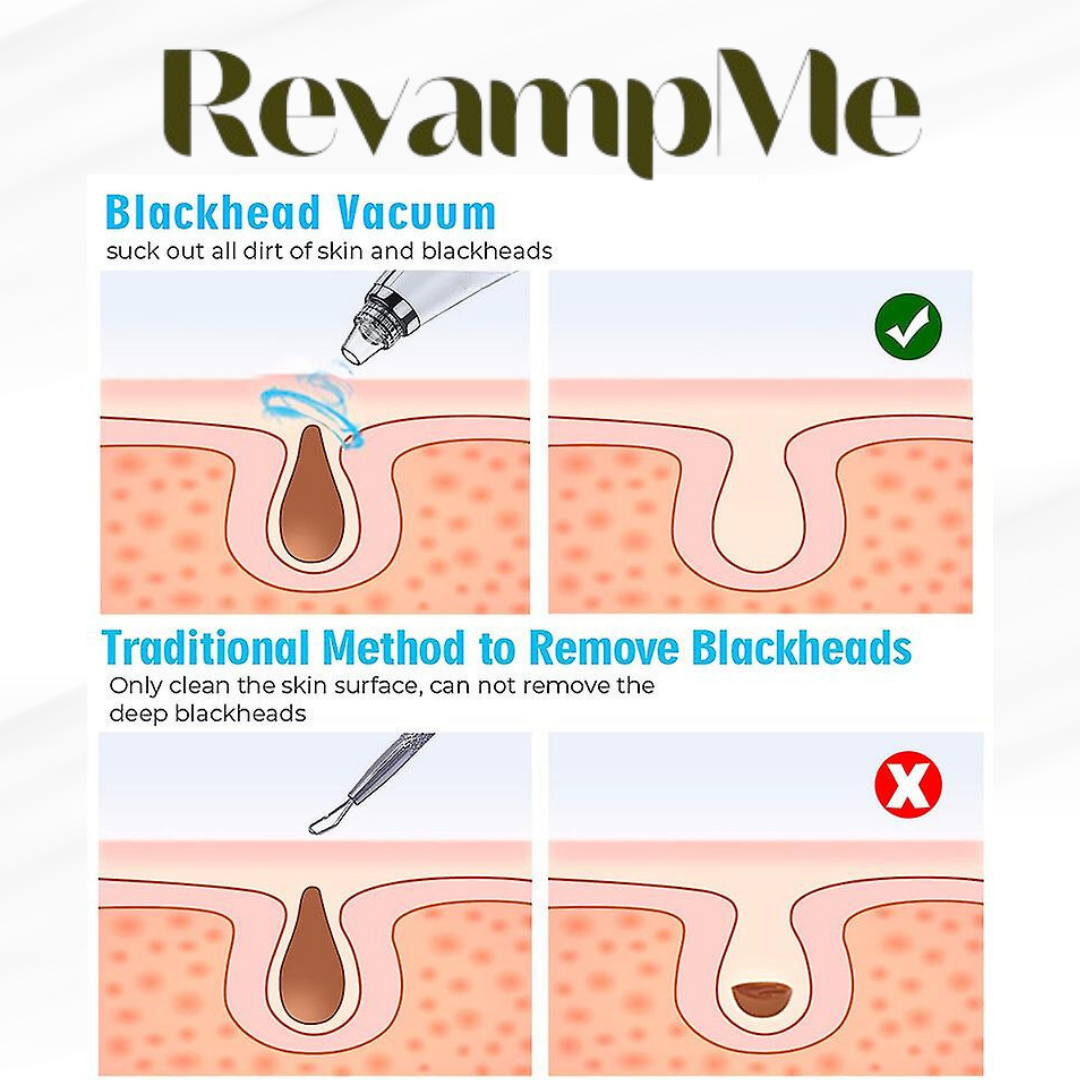 Ultimate Blackhead Remover for Clear - For Radiant Skin!